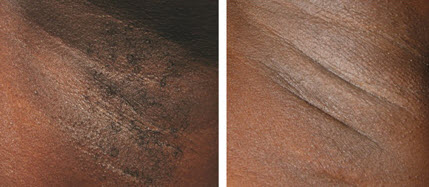 laser hair removal black skin