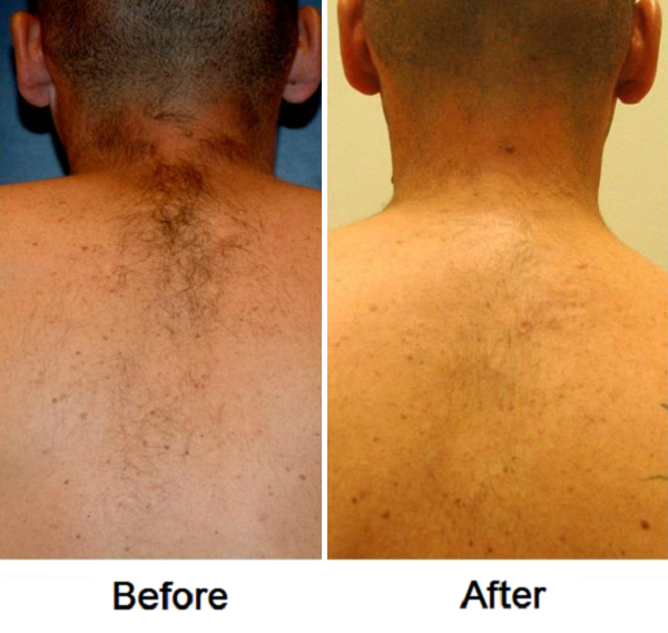 Professional Laser Hair Removal System Facial Hair Removal Laser