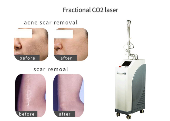 China Vertical Stretch Mark Removal Laser Machine , Laser Skin Care Machine With Air Cooling supplier