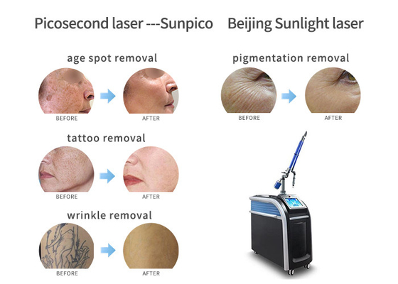 China Skin Whitening Picosecond Laser Tattoo Removal Machine Easy Operation supplier