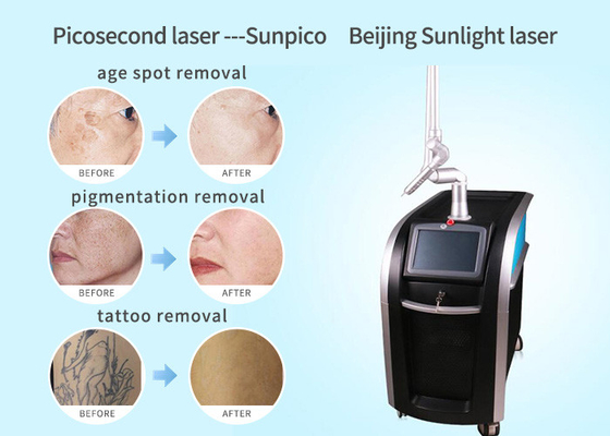 Painless Picosecond Laser Tattoo Removal Machine 755m Two Years Warranty supplier